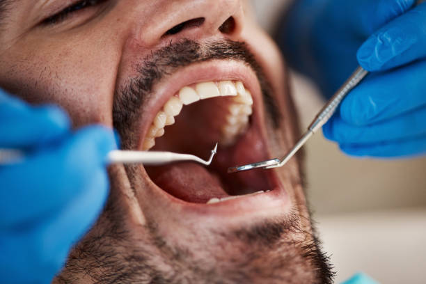 Best Knocked-Out Tooth (Avulsed Tooth) Treatment in Hoyt Lakes, MN
